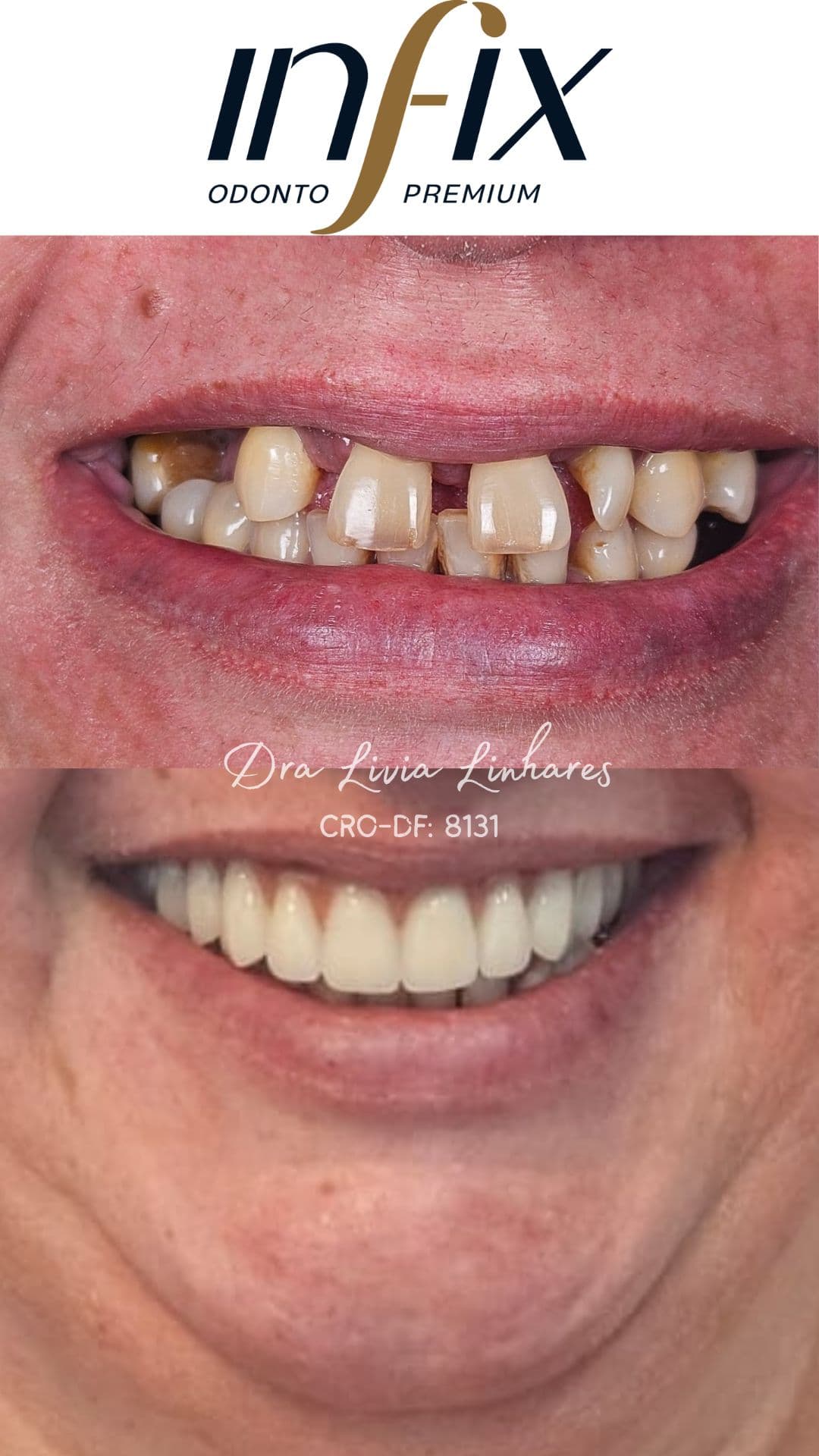 InFix Odonto Premium 